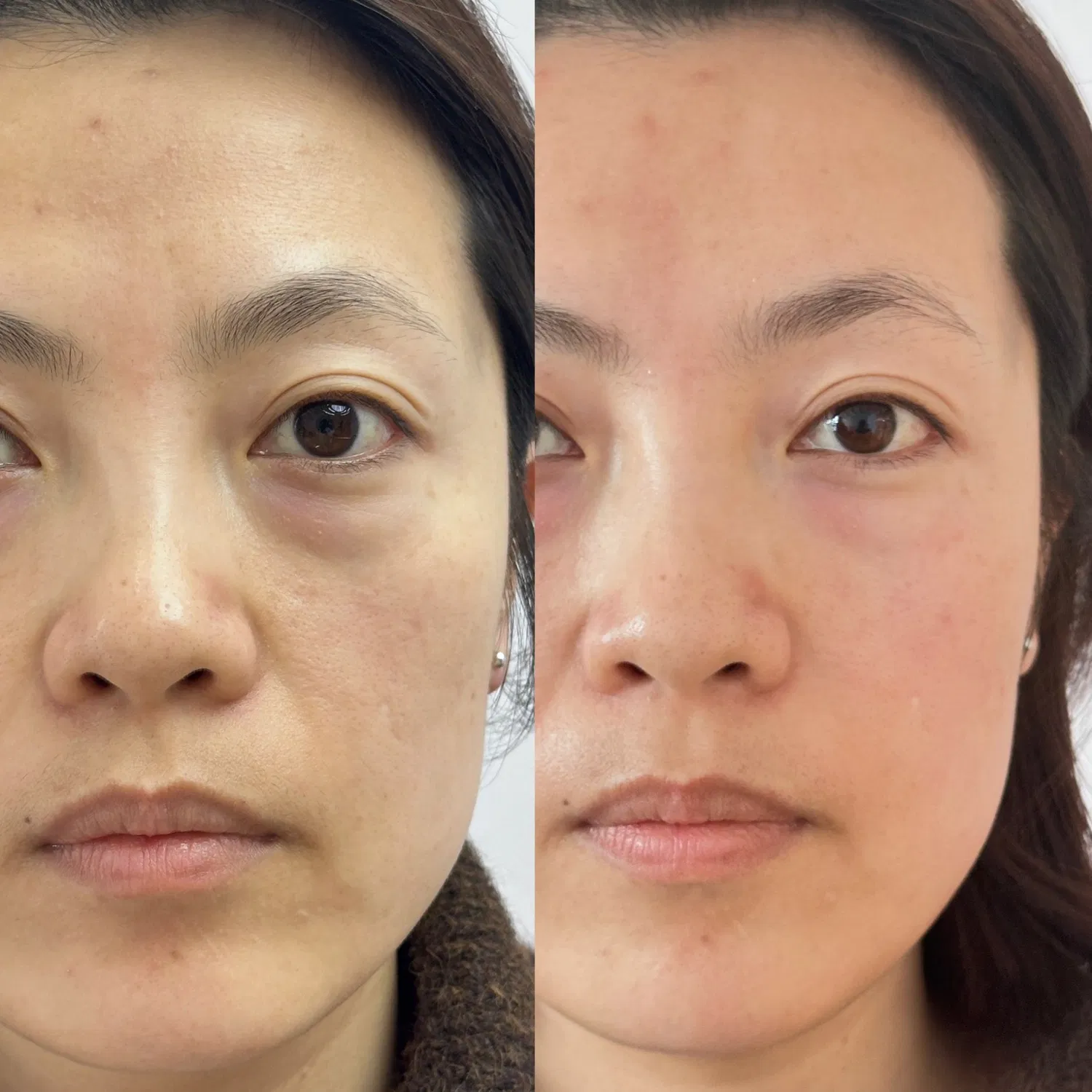 14D Hifu Machine Focused Ultrasound 7D 12D Vertical Transducer Face Lifting 6 in 1 Hifu Machine