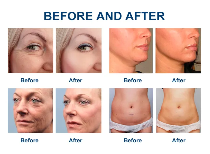 Anti-Aging Black Head Removal Mini Face Lift Painless Skin Tightening Hifu Machine