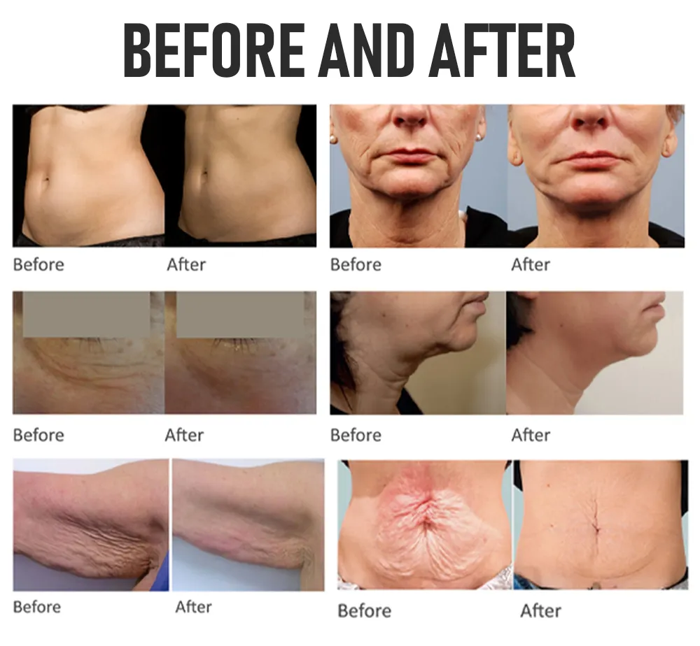 Focused Ultrasound Transducer 12D/7D machine Hifu Skin Tightening Machine